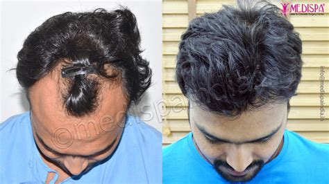 hair transplant cost in mumbai for male